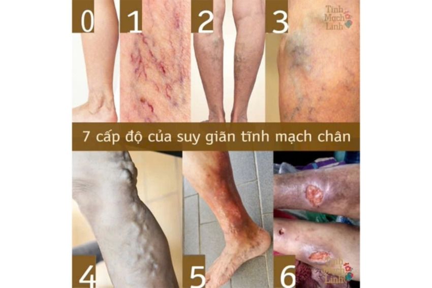 Phòng ngừa bệnh suy giãn tĩnh mạch
