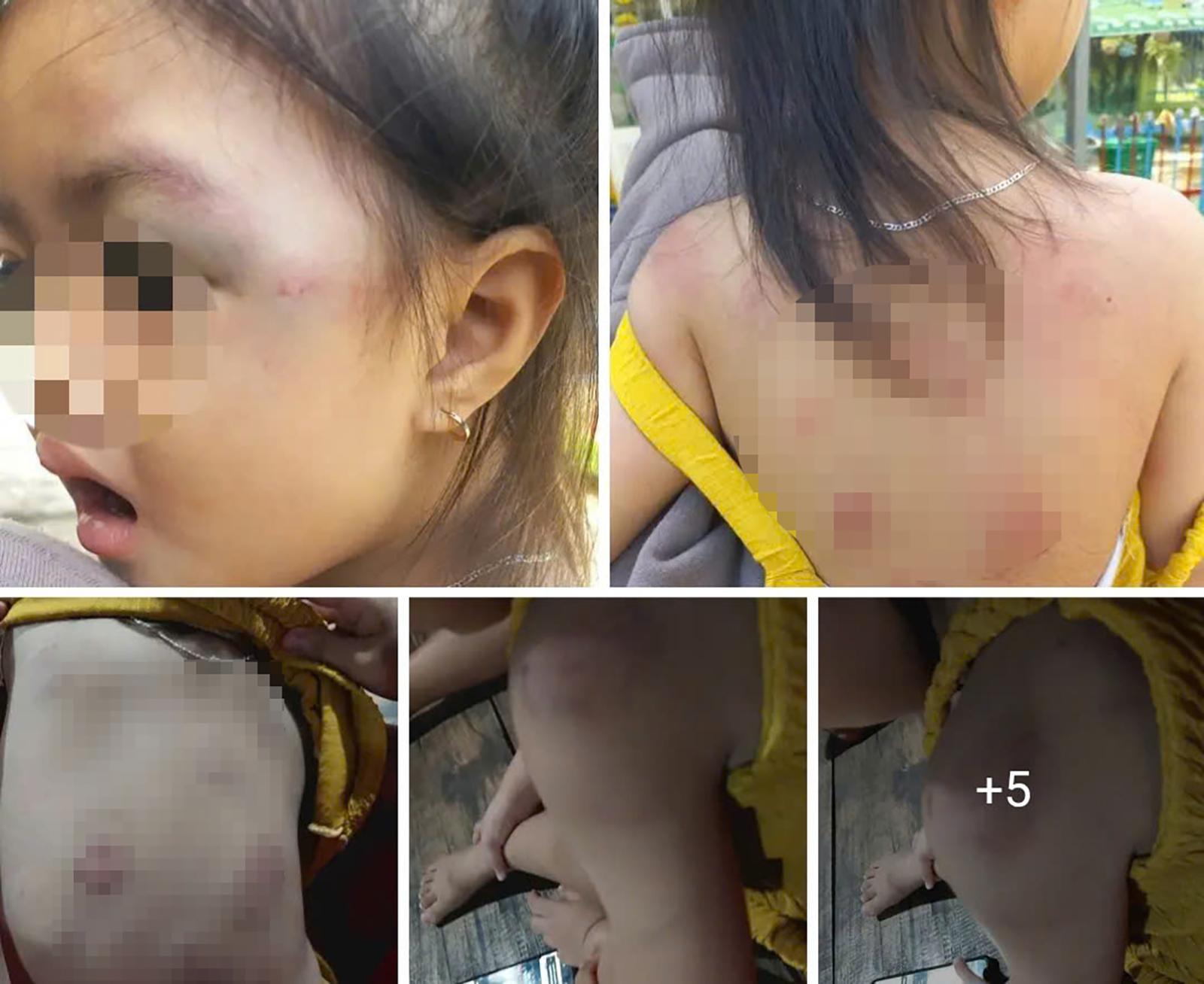 Xác minh vụ phụ huynh tố cáo giáo viên Trường Mầm non Tây Yên làm trẻ bị thương