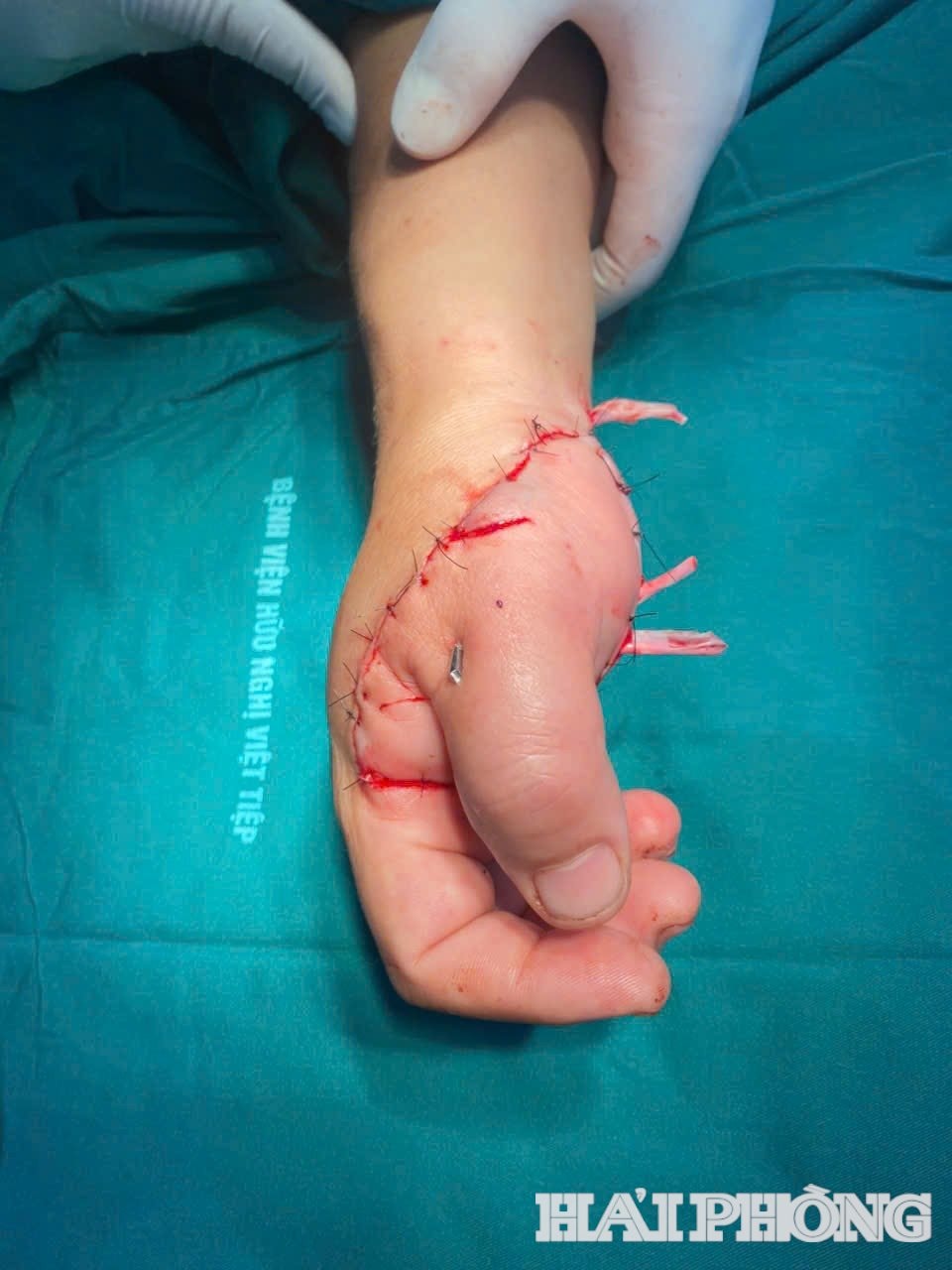 noi - lien-ngon-tay-1