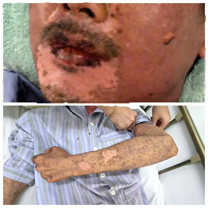 Silicon chống dột từ mái tôn rơi vào người, nam thợ sắt bị sốc phản vệ- Ảnh 1.